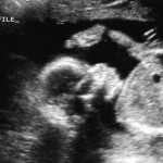 feb22_ultrasound2