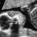 feb22_ultrasound3