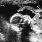 feb22_ultrasound4