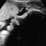 may19_ultrasound